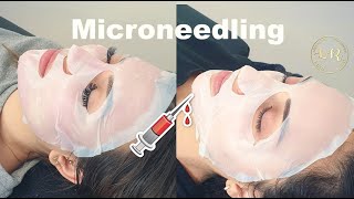 Microneedling ❤️ Steg för Steg Filorga NCTF [upl. by Eicaj]