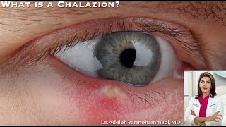 What is a Chalazion quotWhat is that red bump on my eyelidquot [upl. by Negroj]