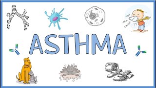 Asthma  Pathogenesis Types Clinical Presentation Morphology Diagnosis and Treatment [upl. by Iyre]