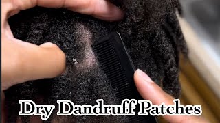 Dandruff Patches PT1  Flaky Dandruff dandruff itchyscalp youtubevideos youtube [upl. by Francyne784]