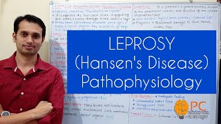 Leprosy Pathophysiology Hansens Disease Part 1 Introduction Types and Etiology [upl. by Whiteley]