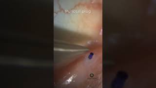 Punctal Plugs for Dry Eye [upl. by Anoif187]