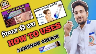 Acne  Acnenok Cream  Acnenok Cream Uses In Hindi  Acne Treatment At Home  Acne Scars [upl. by Foster]