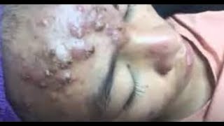 The Most Extreme Blackhead Popping Videos of 2023  satisfying  blackheads  pimple [upl. by Critchfield]