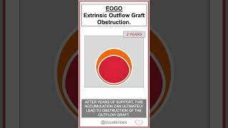 Heartmate LVAD EOGO Extrinsic Outflow Graft Obstruction shorts lvad [upl. by Alhan]