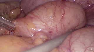 Laparoscopic appendectomy unedited 15112024 [upl. by Shotton]