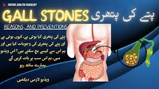 gallstones Unveiled Understanding Causes Symptoms and Treatment Options theradiology5817pain [upl. by Inaoj831]