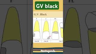 GV black class III IV V [upl. by Daveen]