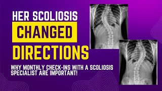 Her Scoliosis Changed Directions The Importance of Scoliosis Monthly “CheckInsquot [upl. by Ferriter158]