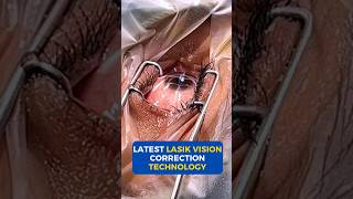 Latest Lasik Vision Correction Technology [upl. by Harned]