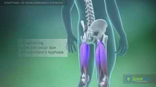 Scheuermann’s kyphosis Symptoms [upl. by Treharne]