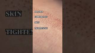 NonInvasive Skin Tightening with Plasma Fibroblast Therapy [upl. by Moureaux88]