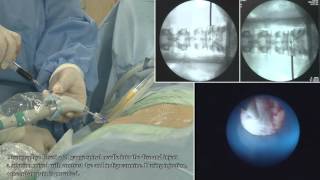 II TELA  Transforaminal Epiduroscopic Laser Annuloplasty   full procedure [upl. by Lahcear]