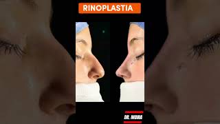 Rinoplastia Ultrasónica en Argentina [upl. by Leede]