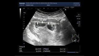 Ultrasound Video showing Early first trimester  6 weeks 01 day  twin Pregnancy [upl. by Entroc]