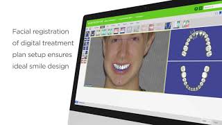 SureSmile Aligner Overview Clinically Proven Clinician Controlled [upl. by Jessie]