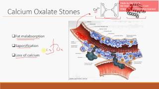 Calcium Oxalate Stones in Crohn Disease [upl. by Cheria]