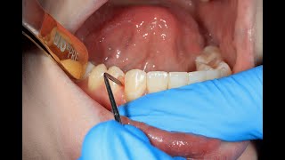 Gum Disease New Treatment Using LASERS amp PRF [upl. by Nur]