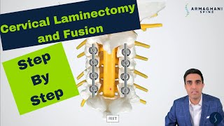 Posterior Cervical Laminectomy and Fusion  Procedure details recovery and expectations [upl. by Rihsab579]