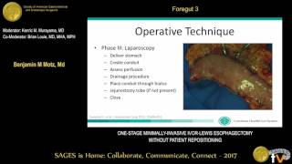 Onestage minimallyinvasive IvorLewis esophagectomy without patient repositioning [upl. by Erle823]