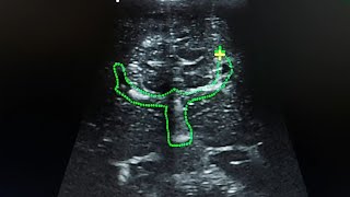 cranial ultrasound  agenesis of the corpus callosum [upl. by Nakah]