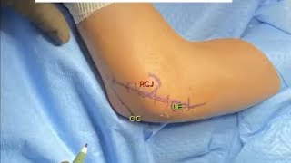 Posterolateral Rotatory Elbow Instability Michell Ruiz MD [upl. by Tillo]