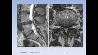 Lumbar Spinal Stenosis Cauda Equina Syndrome Sciatica amp Disc Herniation An Advanced Lecture [upl. by Demahom]