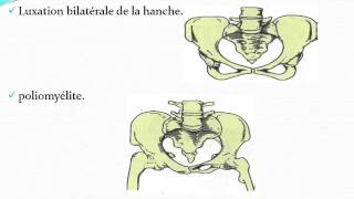 GYNECOLOGIE Dystocie osseuse [upl. by Selmore964]