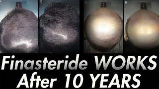 10 YEARS ON FINASTERIDE Results of Italian Study [upl. by Waynant]