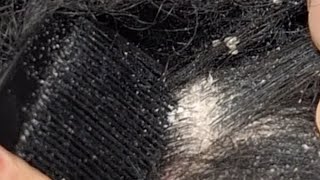 dandruff scratching through locs  scalp psoriasis [upl. by Nomzzaj]