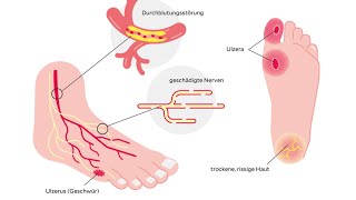 Diabetisches Fußsyndrom [upl. by Annairam323]