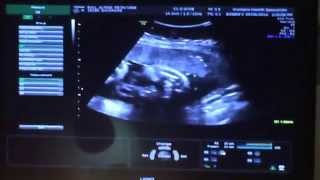 34 weeks and 3 days pregnant ultrasound [upl. by Dearr]