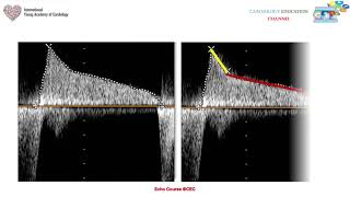 Mitral Stenosis [upl. by Dahsra]