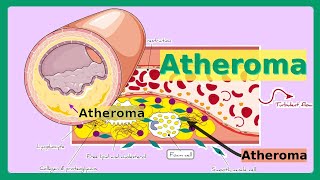 atheroma [upl. by Odranreb]