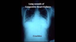 lung sounds  crackles [upl. by Platt]