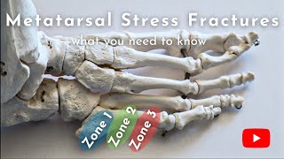 Metatarsal Stress Fractures  Causes Diagnosis amp Treatment [upl. by Cole]