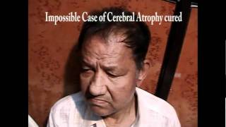 CEREBRAL ATROPHY treatment by acupuncture at SARCGOA Hospital CHANDRAKANT DHARGALKAR English [upl. by De]