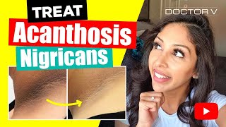 Doctor V  How To Treat Acanthosis Nigrican  Skin Of Colour  Brown Or Black Skin [upl. by Kemppe]