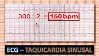 ECG  Eletrocardiograma com Taquicardia Sinusal [upl. by Kilk78]