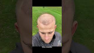 HAIR TRANSPLANT BEFORE AFTER  11 MONTHS [upl. by Thaine]