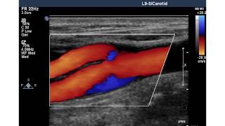 NORMAL CAROTID ARTERY [upl. by Ramhaj512]