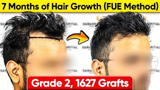 Natural Looking Hairline Transplant in India 1627 Grafts Norwood Grade 2 Hair Transplant Cost [upl. by Hatokad]