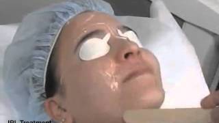 IPL Treatment  Cosmetic Laser Dermatology San Diego [upl. by Stalk158]