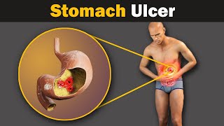 What causes a stomach ulcer Animation [upl. by Amlas205]