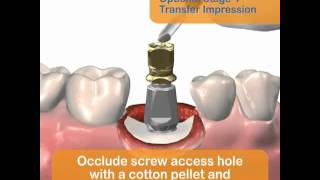 Implantes dentales secuencia completa [upl. by Kaasi]