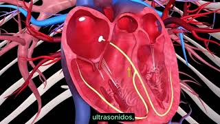 Cardiopatía isquémica [upl. by Nilek521]