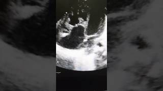 Case 24 echocardiography Ebsteins anomaly in 1 day old baby  born yesterday [upl. by Dowell272]