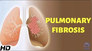 Pulmonary Fibrosis Everything You Need To Know [upl. by Irma]