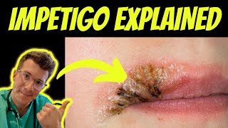 Doctor explains impetigo  causes types and treatment  REAL PHOTOS  Doctor ODonovan [upl. by Claretta]