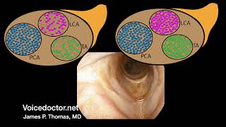 Case study Lateral cricoarytenoid paresis  an example of a hidden vocal cord paralysis [upl. by Attenad]